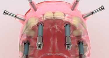 Un nuevo tipo de implantes permiten extraer y sustituir todas las piezas dentales en la misma intervención