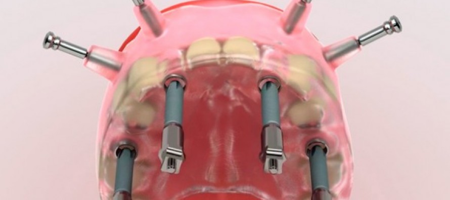 Un nuevo tipo de implantes permiten extraer y sustituir todas las piezas dentales en la misma intervención
