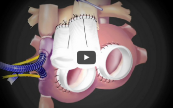 La Clínica Universidad de Navarra implanta el primer corazón artificial total