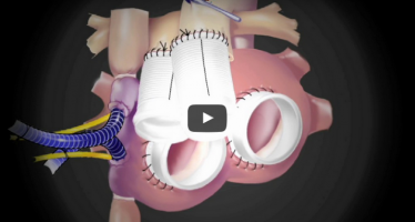 La Clínica Universidad de Navarra implanta el primer corazón artificial total