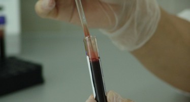Nuevo análisis de sangre para diagnóstico de infarto