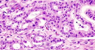 Nuevos descubrimientos en cáncer de páncreas