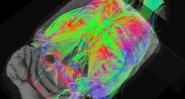 La resonancia magnética detecta de forma precoz alteraciones cerebrales en el Alzheimer