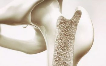Osteoporosis: farmacéuticos advierten de la falta de adherencia a los tratamientos