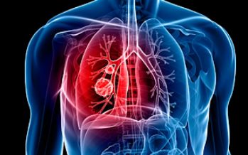 “Pon al cáncer de pulmón contra las cuerdas», nueva campaña de Bristol-Myers Squibb
