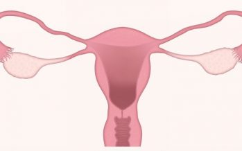 Investigadores identifican la causa genética de la endometriosis