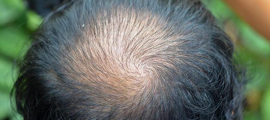 La alopecia difusa provoca una pérdida gradual del cabello