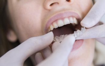 La ortodoncia invisible, cada vez más solicitada por los españoles
