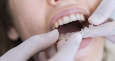 La ortodoncia invisible, cada vez más solicitada por los españoles