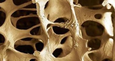 Cuatro de cada cinco pacientes no relacionan su fractura con la osteoporosis
