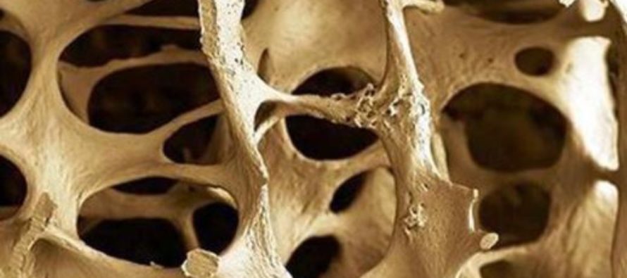 Cuatro de cada cinco pacientes no relacionan su fractura con la osteoporosis