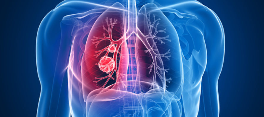 La biopsia líquida, capaz de detectar precozmente el cáncer de pulmón