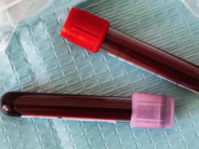 Test de sangre detecta cáncer de colon en su inicio