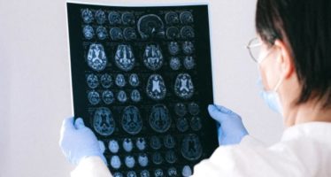 Entre un 10 y un 30% de los pacientes de cáncer desarrollan metástasis cerebral