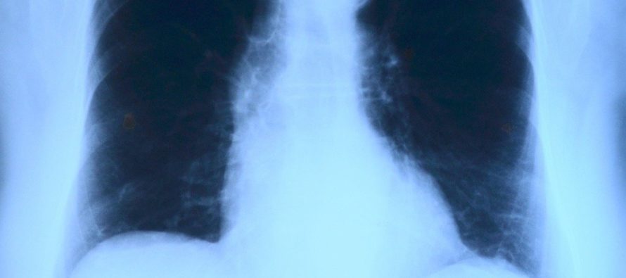 Una radiografía de Tórax para diagnosticar la Covid-19