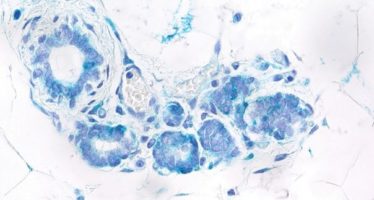 Localizan una conexión entre senescencia y células madre provocada por una proteína iniciadora del cáncer de mama
