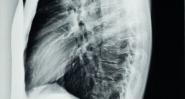 Los pacientes con EPOC tienen más riesgo de sufrir cáncer de pulmón