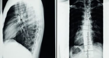 Cáncer de pulmón: ¿Cuáles son los primeros signos de alerta?