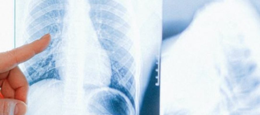 Cáncer de pulmón: Menos de un 25% de los casos se detecta en una fase que facilite la curación