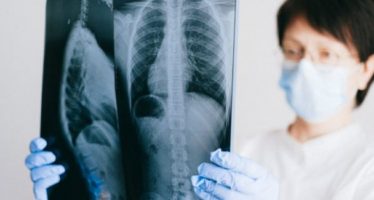 Cáncer de pulmón: Un simple análisis de sangre predice quién puede beneficiarse de su detección