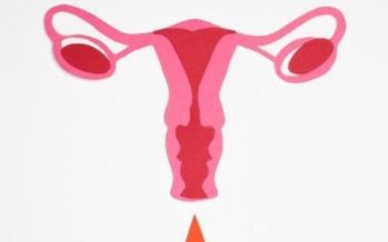 Miomas uterinos mediante embolización