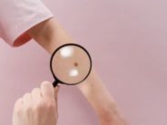 Una vacuna experimental contra el melanoma reduce un 42% el riesgo de recaída o muerte
