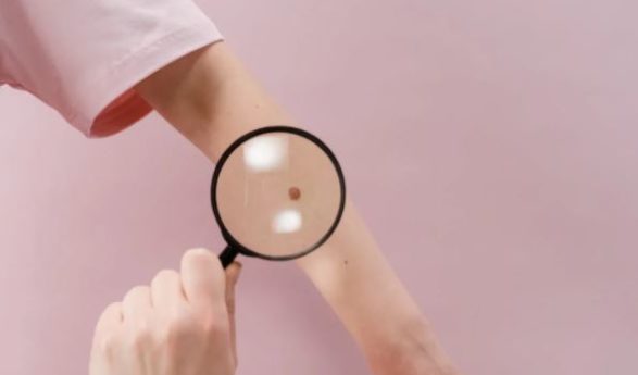 Una vacuna experimental contra el melanoma reduce un 42% el riesgo de recaída o muerte