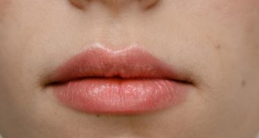 ¿Cómo prevenir el herpes labial?