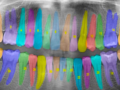 Inteligencia artificial para una medicina periodontal de precisión