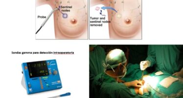 La Luz incorpora Sonda Gamma intraoperatoria para cirugía radioguiada oncológica