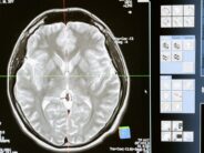 El Hospital Sant Joan de Déu prueba una nueva estrategia pionera para combatir uno de los tumores cerebrales infantiles más letales
