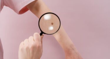 ‘Los Vigilantes de la Piel’ una campaña para concienciar sobre el melanoma