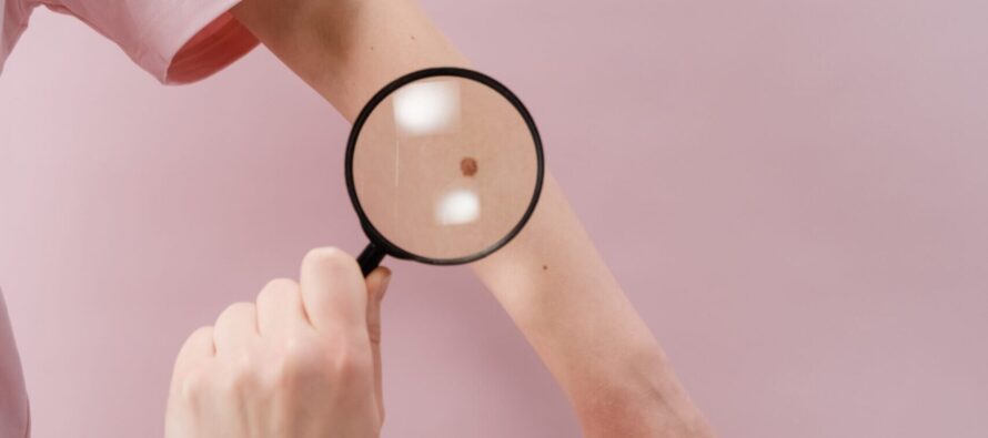 ‘Los Vigilantes de la Piel’ una campaña para concienciar sobre el melanoma