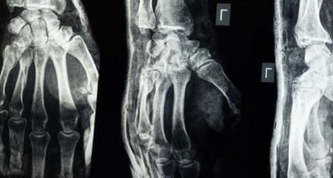 Osteoporosis: Pasos para prevenirlos