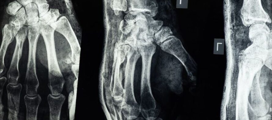 Osteoporosis: Pasos para prevenirlos