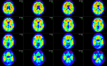 Eficacia de donanemab en la reducción de la progresión del deterioro cognitivo de Alzheimer