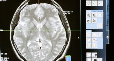 Importante avance en un tipo de tumor cerebral agresivo