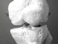 Una terapia desarrollada por investigadores españoles reduce un 94% las fracturas por osteoporosis