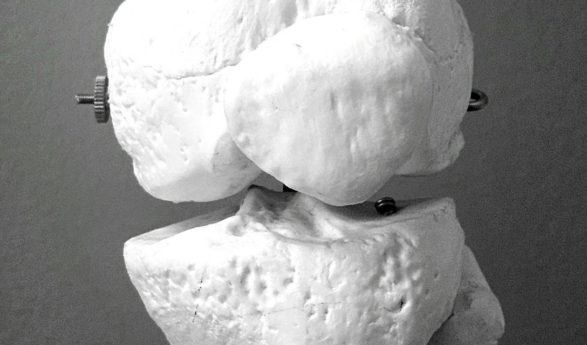 Una terapia desarrollada por investigadores españoles reduce un 94% las fracturas por osteoporosis
