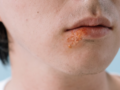Proteger los labios del sol reduce la reaparición del herpes