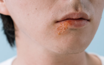 Proteger los labios del sol reduce la reaparición del herpes