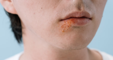 Proteger los labios del sol reduce la reaparición del herpes