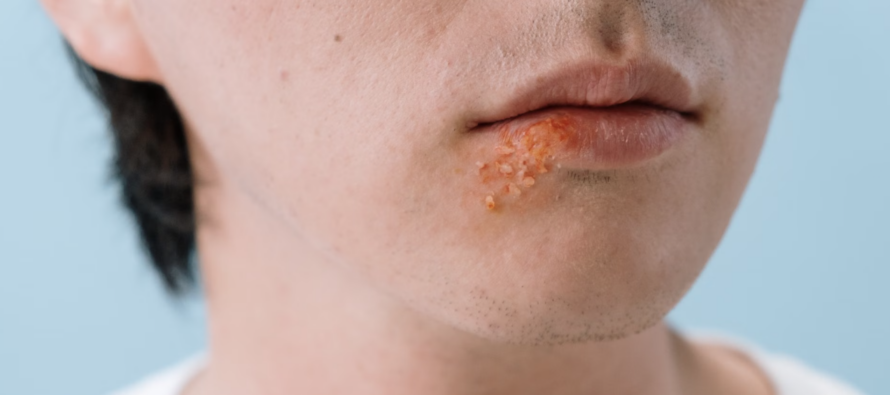 Proteger los labios del sol reduce la reaparición del herpes