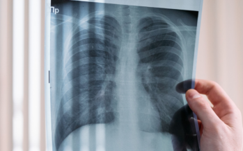 Llega a España ‘mepolizumab’, una nueva terapia biológica para la EPOC