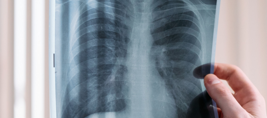 Llega a España ‘mepolizumab’, una nueva terapia biológica para la EPOC